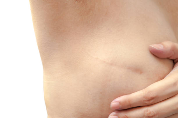 Close-up of a bare torso with a small horizontal scar along the side, while a hand gently pinches the skin.