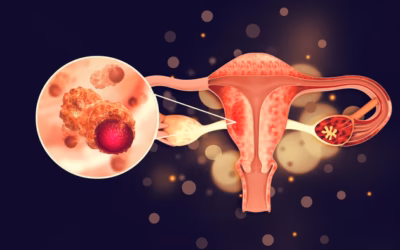 Can Ovarian Cancer Be Treated Without Removing Both Ovaries?