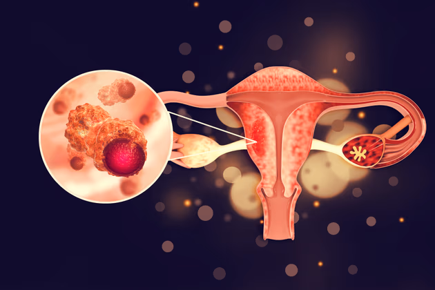 Can Ovarian Cancer Be Treated Without Removing Both Ovaries - MACS Clinic