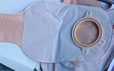 Can You Avoid a Colostomy Bag With Rectal Cancer Surgery?