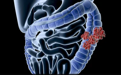  Can Young People Get Colon Cancer?