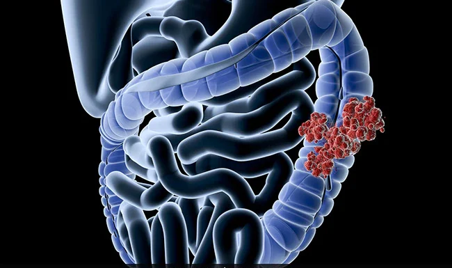 Can Young People Get Colon Cancer - MACS Clinic