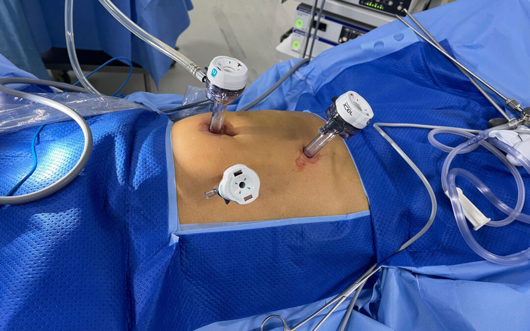 Is Laparoscopic Surgery Safe for Stomach Cancer - MACS Clinic
