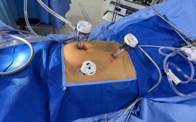 Is Laparoscopic Surgery Safe for Stomach Cancer?