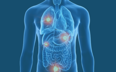 What Is Metastatic Cancer and How It Spreads?