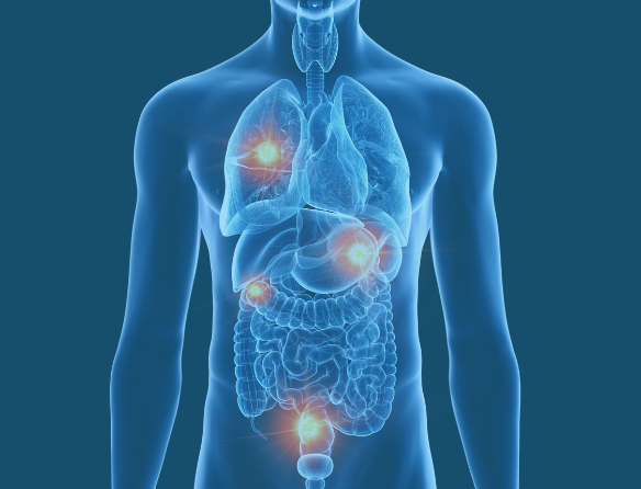 Metastatic cancer and how it spreads explained by Dr Sandeep Nayak