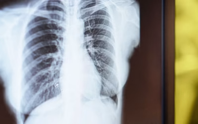 What Does Stage 3 Cancer Mean for Survival?