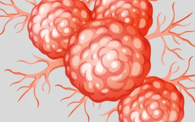 Stage 1 vs Stage 2 Cancer Differences
