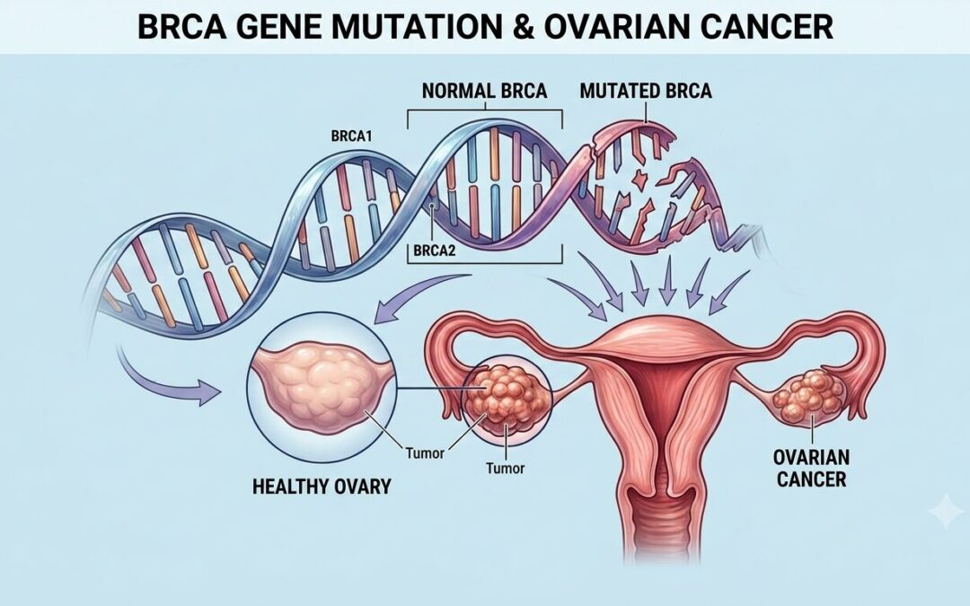 Can BRCA Gene Mutation Cause Ovarian Cancer