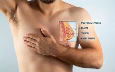 Can Breast Cancer Occur in Men?