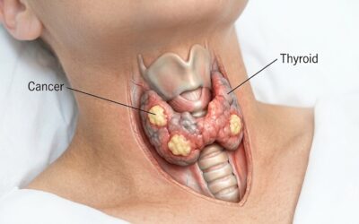 Can Thyroid Cancer Spread to Lymph Nodes?