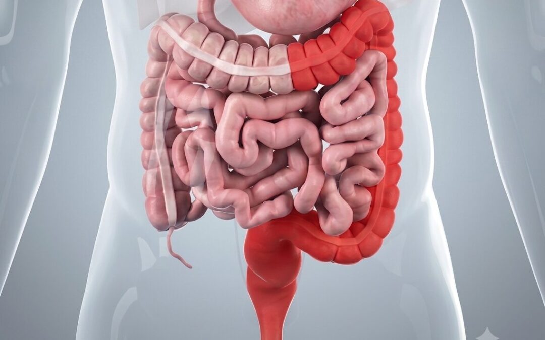 Can Ulcerative Colitis Lead to Colon Cancer