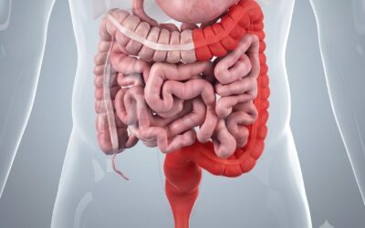 Can Ulcerative Colitis Lead to Colon Cancer?