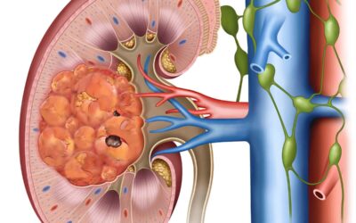 Kidney Cancer Without Removing the Whole Kidney?