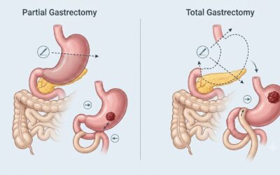 Partial vs Total Gastrectomy: When Is Each Used?