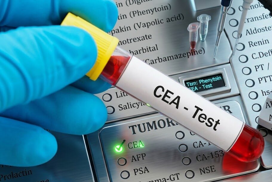 What Is a CEA Blood Test for Colon Cancer