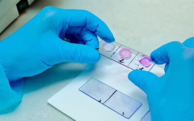 When Is a Second Biopsy Needed After First Results?