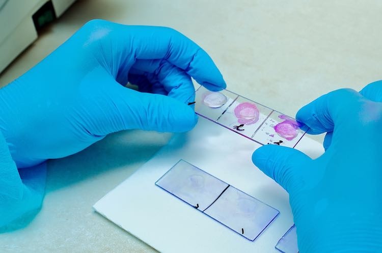 When Is a Second Biopsy Needed After First Results