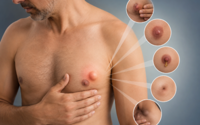 What Are the First Signs of Male Breast Cancer?