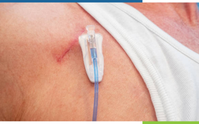 What Is a Port-a-Cath Used for in Chemo?