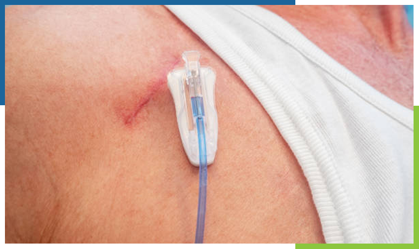What Is a Port-a-Cath Used for in Chemo