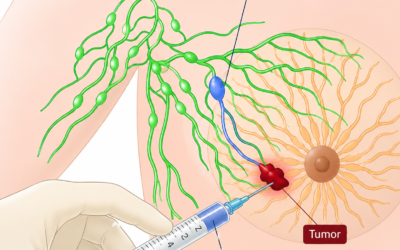 When Can Sentinel Node Biopsy Replace Dissection?