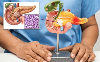 Why Is Pancreatic Cancer Usually Found So Late?