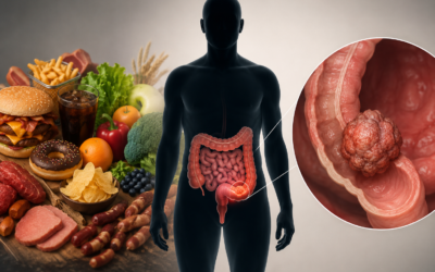 Can Diet Cause Early-Onset Colorectal Cancer?