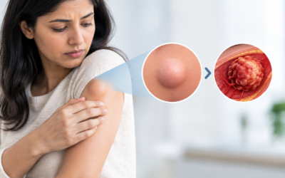 Can Sarcoma Be Mistaken for a Harmless Lump for Years?
