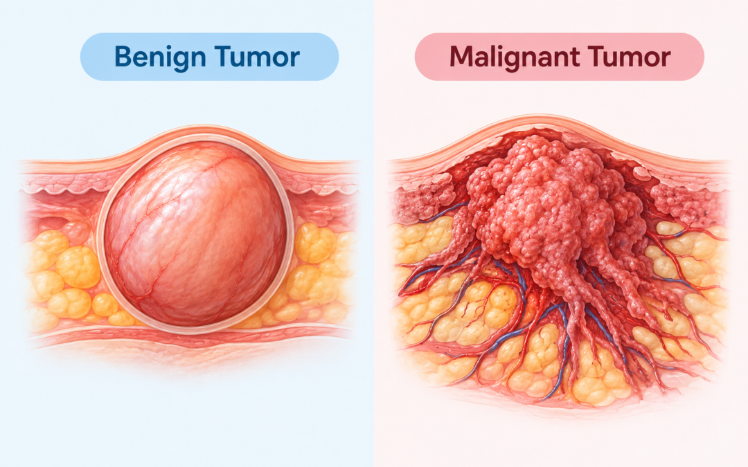 Benign vs Malignant Tumors: What's the Difference?