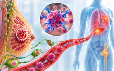 How Quickly Does HER2-Positive Breast Cancer Spread?