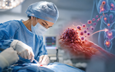 Can Cancer Surgery Make Cancer Spread? | MACS Clinic