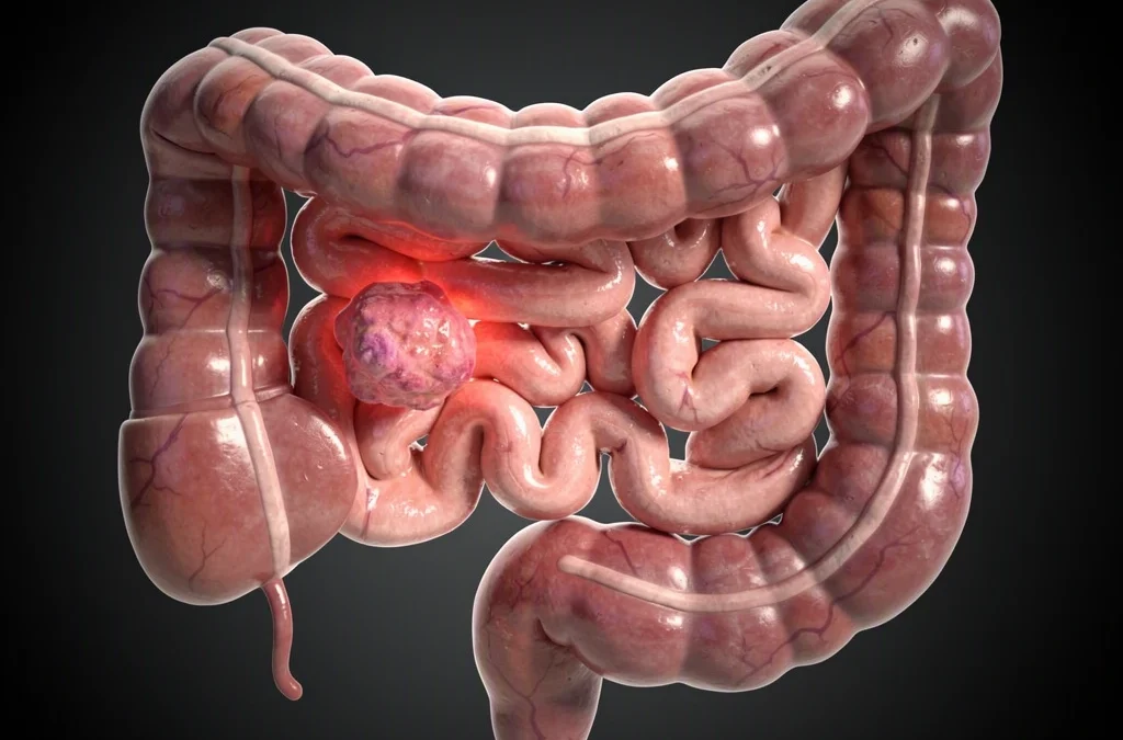 What Are the Early Symptoms of Colon Cancer
