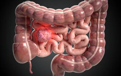 What Are the Early Symptoms of Colon Cancer?
